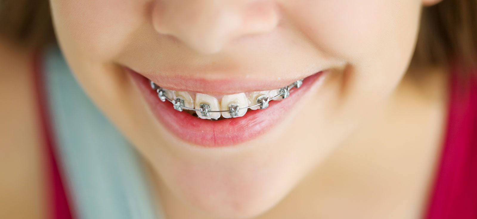 Interceptive Orthodontics Kenmore WA Kenmore Pediatric Dentistry