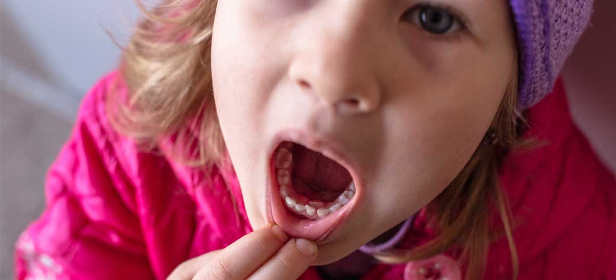 What Parents Need to Know About Shark Teeth