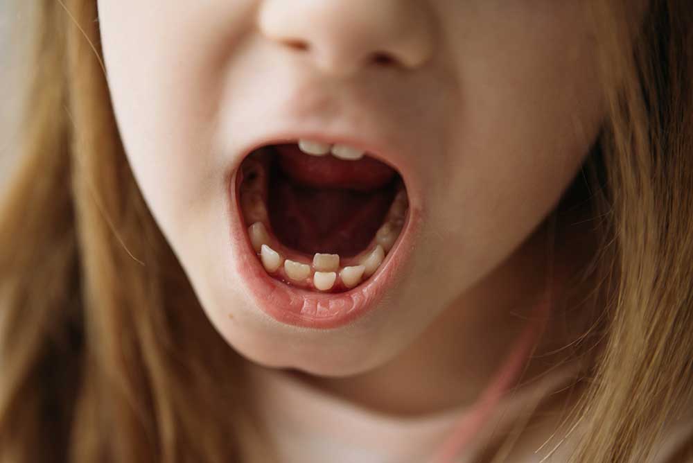 Shark Teeth in Kids | Kenmore, WA |Kenmore Pediatric Dentistry