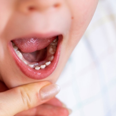 does-your-child-have-shark-teeth-what-this-means-for-their-oral-health-banner