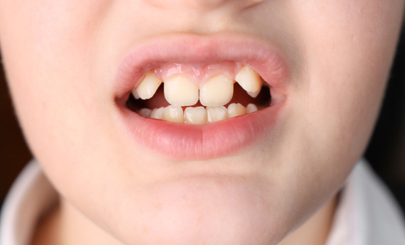 What Shark Teeth Means for a Child's Oral Health | Kenmore, WA ...