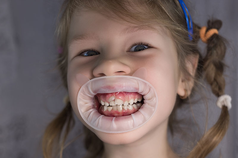 does-your-child-have-shark-teeth-what-this-means-for-their-oral-health-strip4