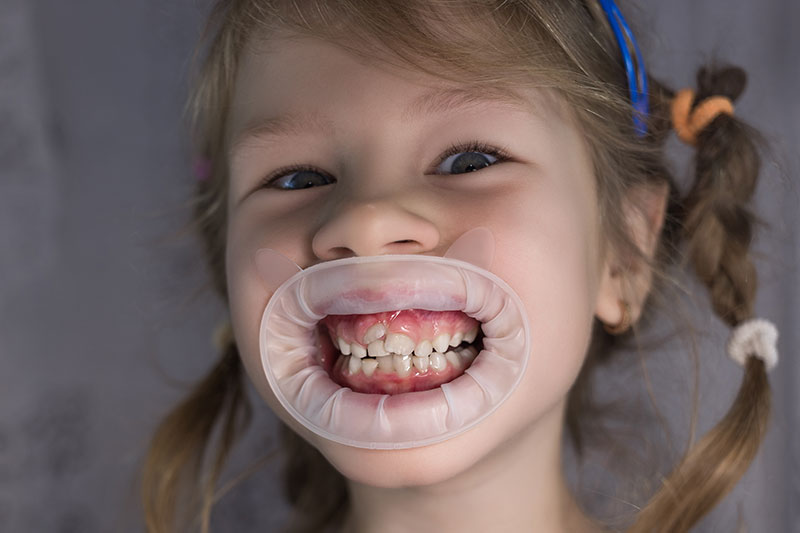 What Shark Teeth Means for a Child's Oral Health | Kenmore, WA ...