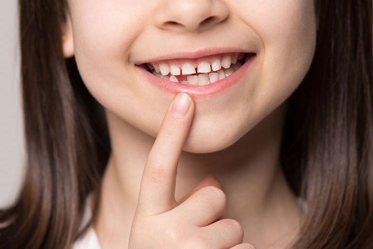 How To Handle Six Year Old Molars Kenmore Wa Kenmore Pediatric Dentistry