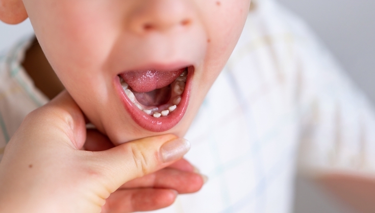 Your Child Cracked a Tooth, Now What? A Guide to Handling Dental Emergencies for Kids